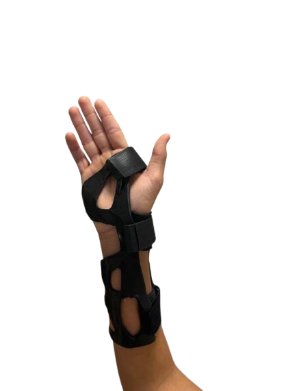 A custom 3D-printed HappyCasts wrist splint worn on a hand
